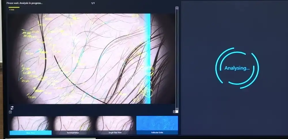 TrichoScan analysing a dermatoscope image of the scalp: hairs are traced and measured, then a summary of hair density, thickness groups and follicular units appears